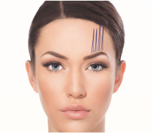 Assufil PDO Threads: Non-Surgical Lifting and Rejuvenation